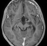Ressonância magnética após a cirurgia com a retirada total do tumor.