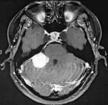 Ressonância de paciente com meningeoma petroso direito antes da cirurgia.