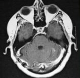 Ressonância magnética depois da cirurgia mostrando sua retirada total.