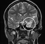 Ressonância de menina de 13 anos com epilepsia há 3 anos com tumor cerebral.