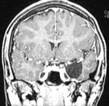 Ressonância após a cirurgia no cérebro com remoção total do tumor. Ela ficou curada da epilepsia.