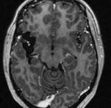 Ressonância após a cirurgia com remoção total do tumor.