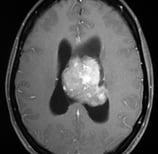 Ressonância de paciente com cefaleia e vômitos com volumoso tumor antes da cirurgia no cérebro.