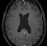 Ressonância magnética após a cirurgia demonstrando a retirada total do tumor.
