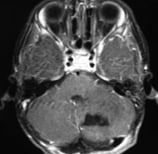 Ressonância magnética depois da cirurgia com a retirada total do tumor.