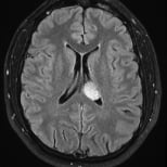 Ressonância de paciente com cefaleia e tumor no ventrículo esquerdo antes da cirurgia no cérebro.a.