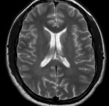 Ressonância após a cirurgia com remoção total do tumor. 