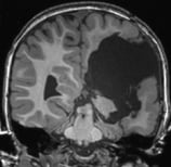 Resssonância após a cirurgia no cérebro (hemisferotomia). Ela ficou sem epilepsia.