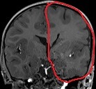 Ressonância de menina de 3 anos com epilepsia desde os 6 meses. Hemimegalencefalia à esquerda.