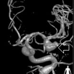 Angiografia digital projeção frontal. A seta indica aneurisma cerebral.