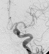 Angiografia digital projeção frontal após a cirurgia no cérebro e clipagem do aneurisma cerebral.