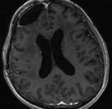 Ressonância após a cirurgia com remoção total do tumor e paciente sem epilepsia.