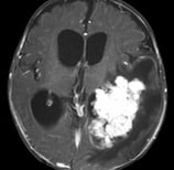 Ressonância de criança com aumento da cabeça e volumoso tumor antes da cirurgia no cérebro.