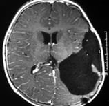 Ressonância magnética após a cirurgia com a remoção total do tumor.