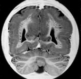 Ressonância de menino de 2 anos com grave malformação cerebral bilateral e epilepsia grave.