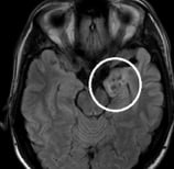 Ressonância de homem de 33 anos com crises epilépticas desde 10 meses de idade com tumor cerebral.
