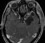 Ressonância após a cirurgia no cérebro e remoção total do tumor. Sem crises após a cirurgia.