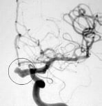 Angiografia projeção frontal evidenciando um aneurisma cerebral.