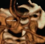 Reconstrução 3D da angiotomografia projeção perfil mostrando o volumoso aneurisma cerebral.