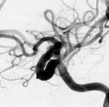 Angiografia após a cirurgia no cérebro e clipagem do aneurisma cerebral. Projeção perfil.