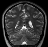 Ressonância de moça epiléptica com tumor no cíngulo esquerdo antes da cirurgia no cérebro.