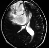 Ressonância de mulher de 48 anos com crises epilépticas e um volumoso tumor cerebral.