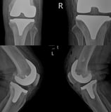 protesis de rodilla