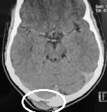 Tomografia de menino de 12 anos com abaulamento occipital há 2 semanas. Tumor ósseo.