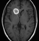 Ressonância de paciente epiléptica antes da cirurgia no cérebro.