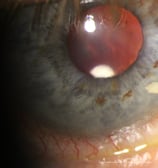 Alloflo scleral implant