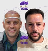 Before & after FUE hair transplant at HairTurk: Full bald man to full hair, smiling.