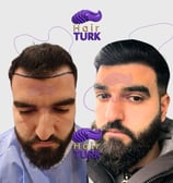 Before & after DHI hair transplant at HairTurk: bald man to full hair, smiling