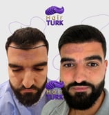 Before & after FUE hair transplant at HairTurk: Full bald man to full hair, smiling.