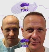 Before & after FUE hair transplant at HairTurk: Full bald man to full hair, smiling.