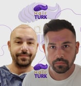 Before & after FUE hair transplant at HairTurk: bald man to full hair, smiling