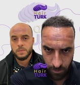 Before & after FUE hair transplant at HairTurk: Full bald man to full hair, smiling.