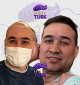 Before & after FUE hair transplant at HairTurk: Full bald man to full hair, smiling.
