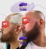 Before & after DHI beard transplant at HairTurk: bald man to full beard, smiling