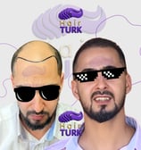 Before & after FUE hair transplant at HairTurk: Full bald man to full hair, smiling.
