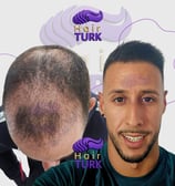 Before & after FUE hair transplant at HairTurk: bald man to full hair, smiling