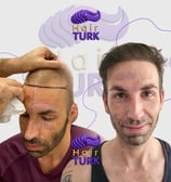 Before & after hair transplant at HairTurk: bald man to full hair, smiling
