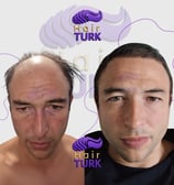Before & after hair transplant at HairTurk: full bald man to full hair.