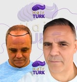 Before & after FUE hair transplant at HairTurk: Full bald man to full hair, smiling.