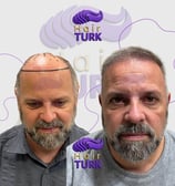 Before & after hair transplant at HairTurk: elderly bald man to full hair, smiling