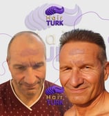 Before & after hair transplant at HairTurk: elderly bald man to full hair, smiling