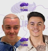 Before & after FUE hair transplant at HairTurk: bald man to full hair, smiling