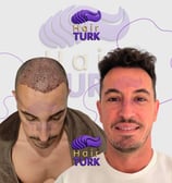 hair transplant clinic in turkey before after