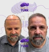 Hair transplant clinic in turkey before after