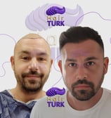hair transplant clinic in turkey before after