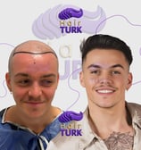 hair transplant clinic in turkey before after